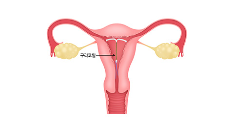 일반 자궁내장치(구리루프)