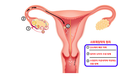 사후피임약